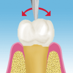 歯の動揺度検査