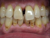 歯周病治療 治療後